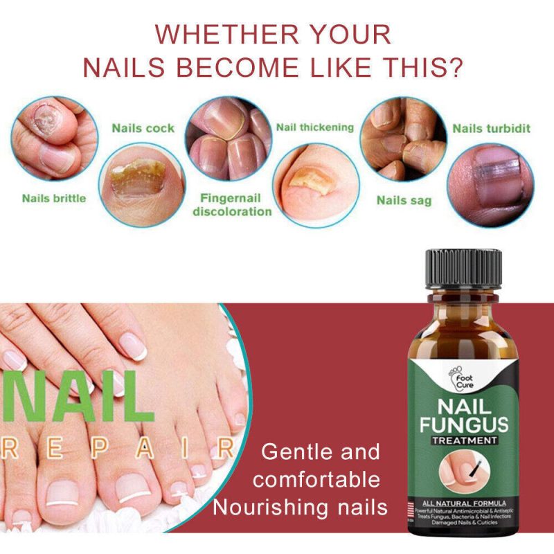 Foot Cure Nail Fungus Solution – Yeh Cheezzz